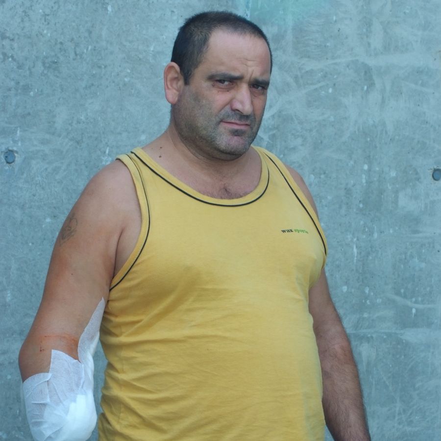 Милко Михалев загуби дясната си ръка вследствие на манипулация, назначена от кардиолог