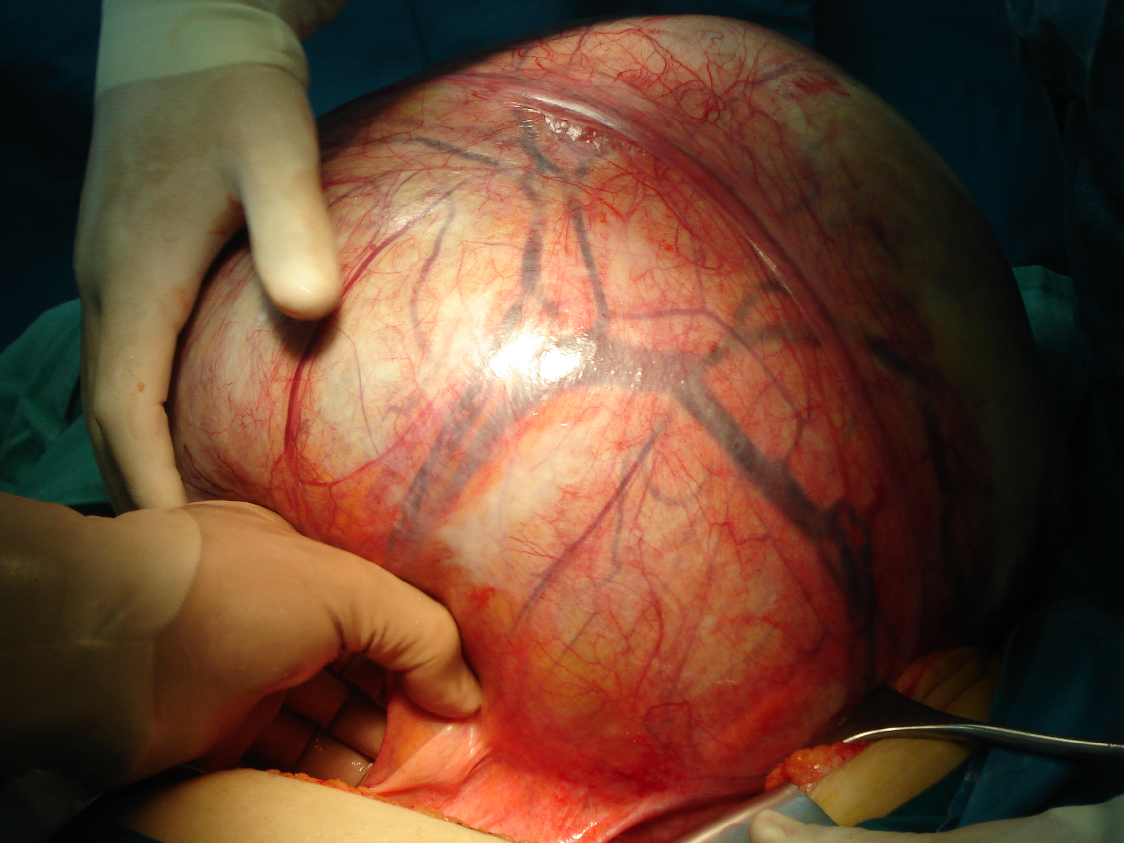 20-килограмовият тумор, изваден от корема на 53-годишната жена