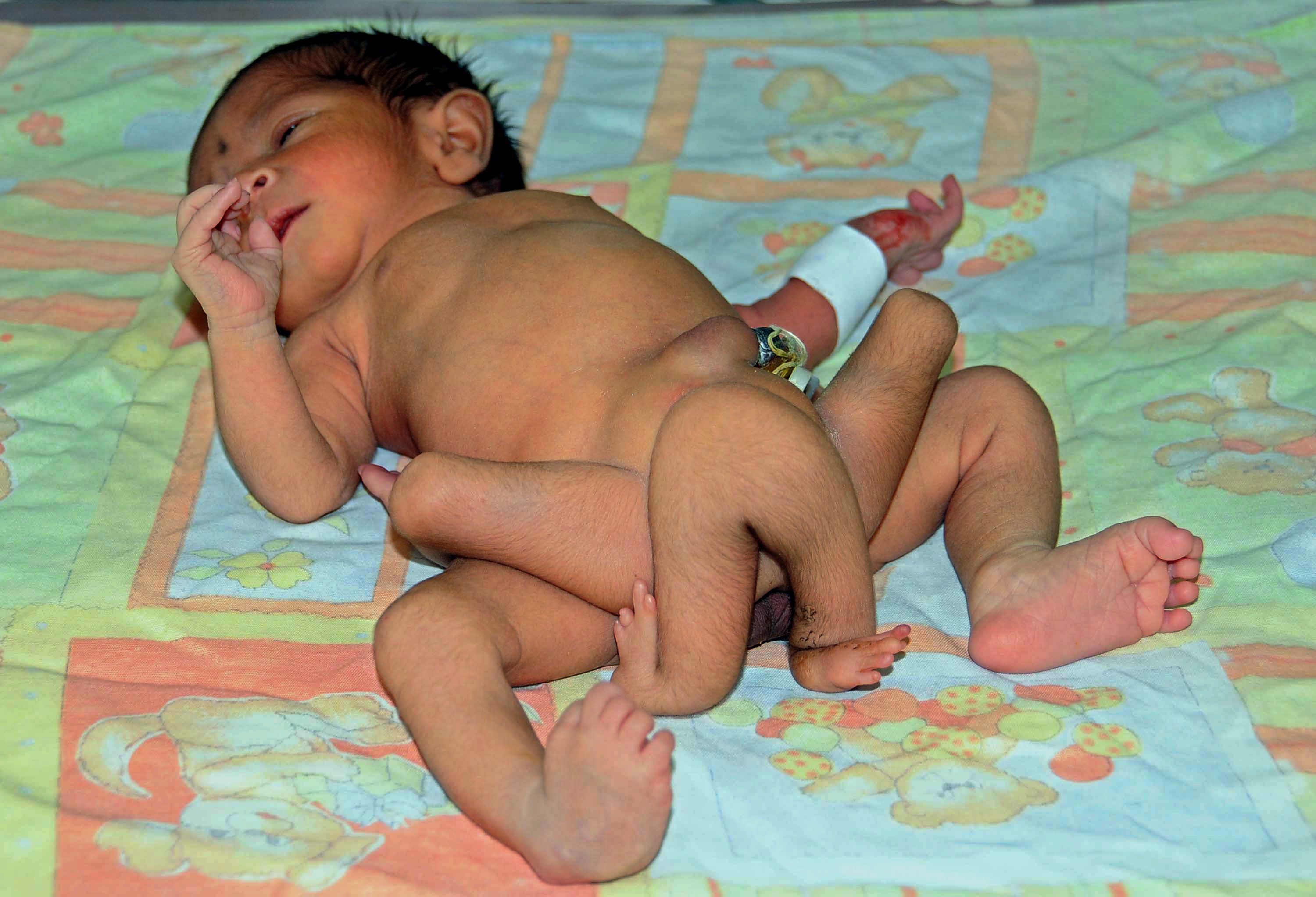 Лекари спасиха шесткрако бебе, родено в Пакистан