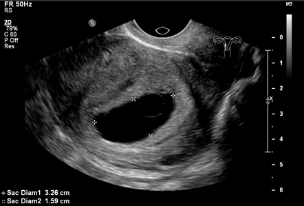 Oплодената яйцеклетка може да се захване успешно за маточната стена, но от нея да не се развие ембрион