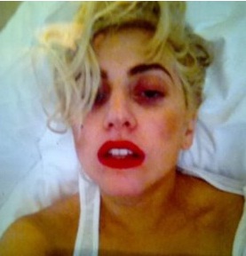 Лейди Гага показа последиците от удара с пилон
