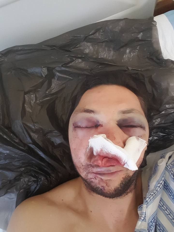 Журналистът Стоян Тончев, който бе пребит в Поморие, публикува свои снимки от болницата в Бургас