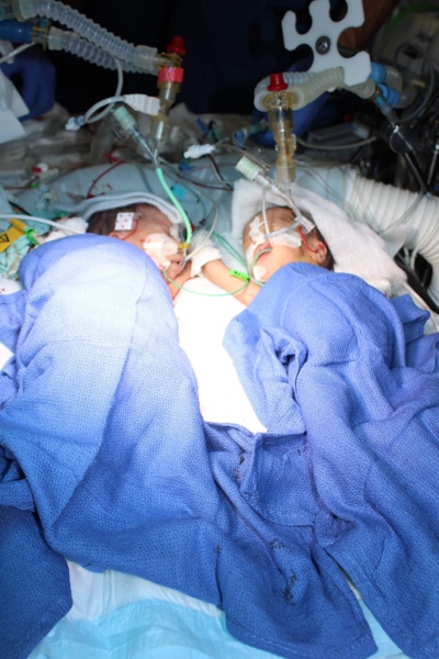 В Швейцария успешно разделиха сиамски близначки на осем дни