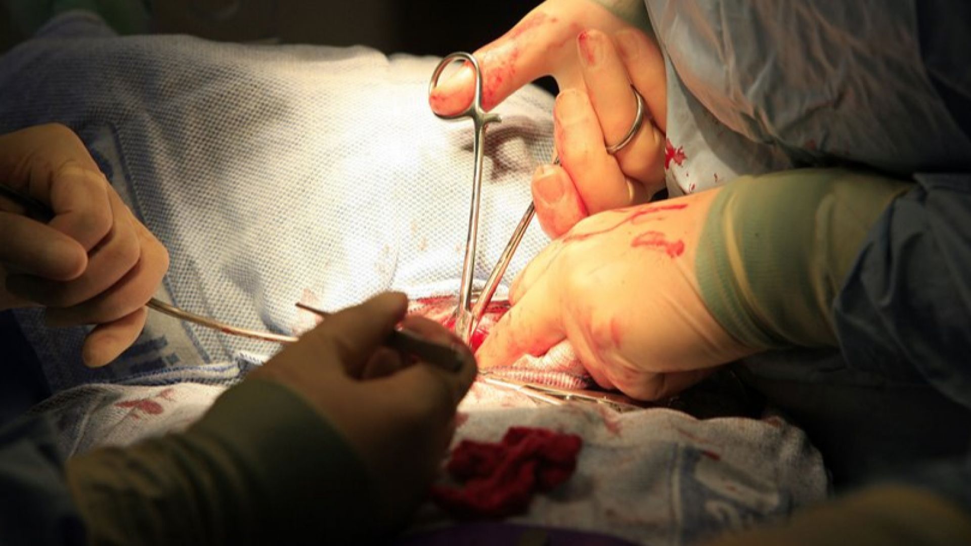 Първа белодробна трансплантация в Румъния