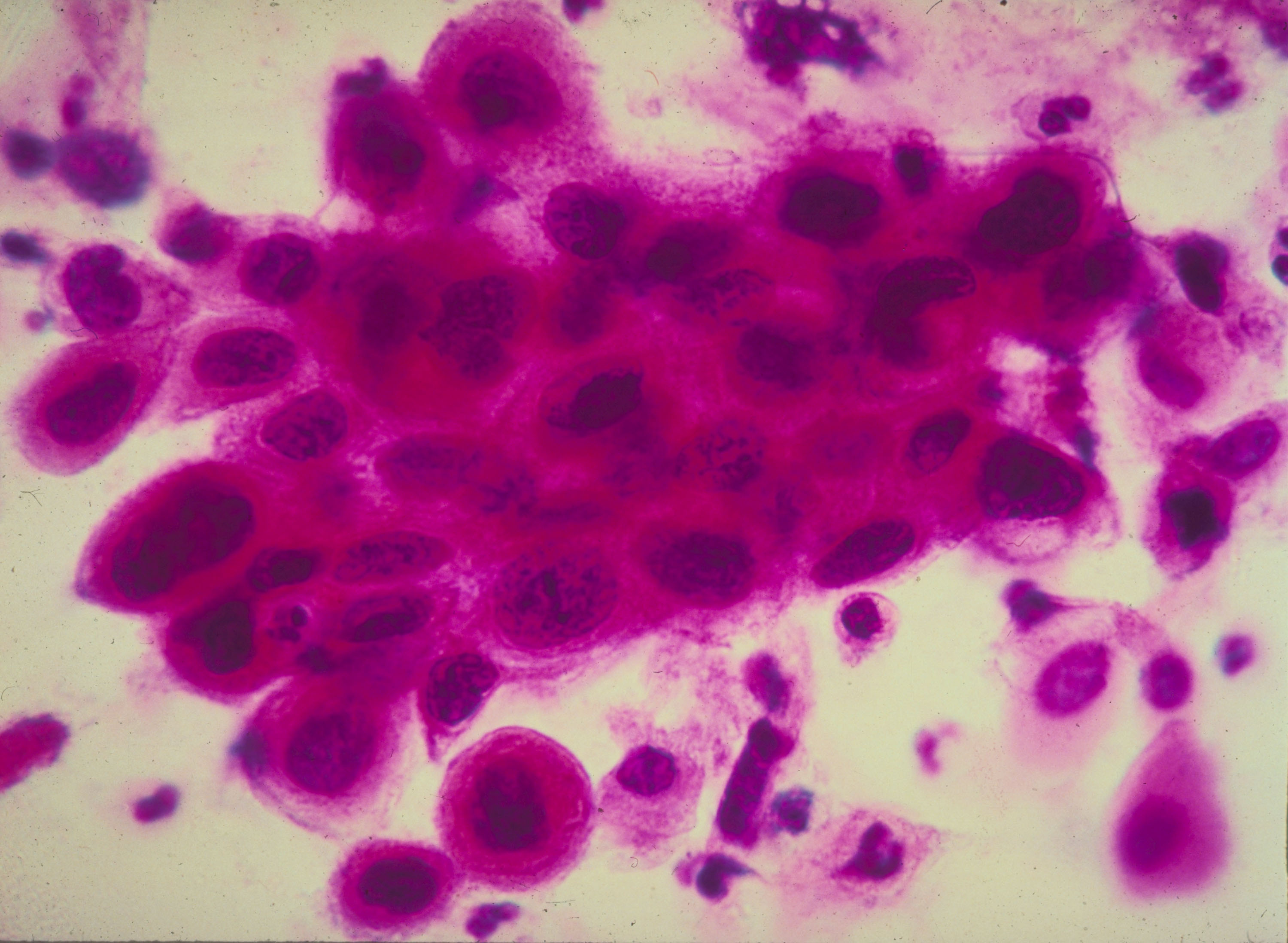 Ракови клетки на матката
