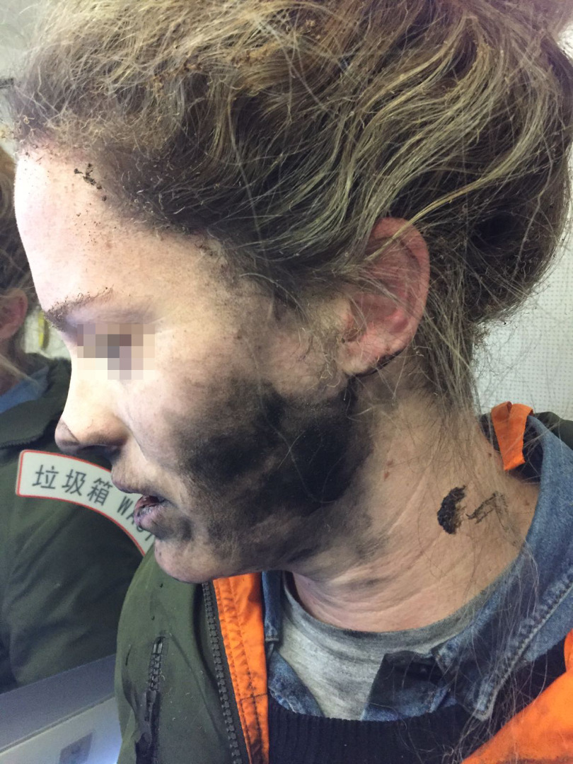 Безжични слушалки избухнаха върху главата на жена (снимки)