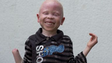 Режат телата на танзанийски деца албиноси, за да варят отвари за късмет