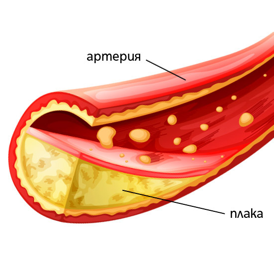 Натрупването на холестеролни плаки може да доведе до запушване на кръвоносните съдове и тежки здравословни проблеми
