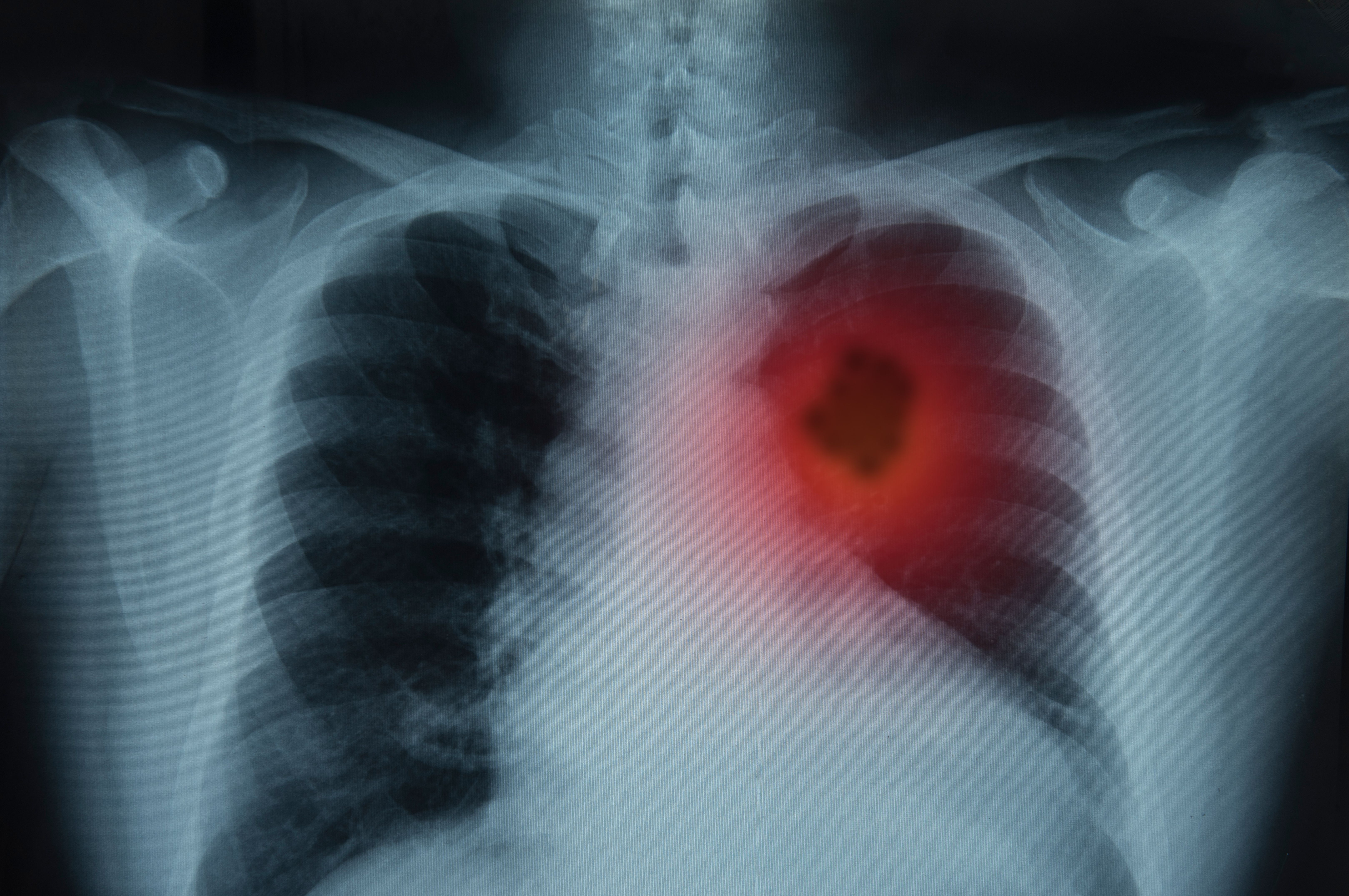 Ракът на белия дроб е най-смъртоносното онкозаболяване | Днес.dir.bg