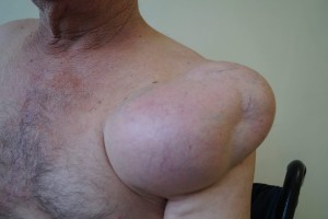Отстраниха огромен тумор на рамото на пациент