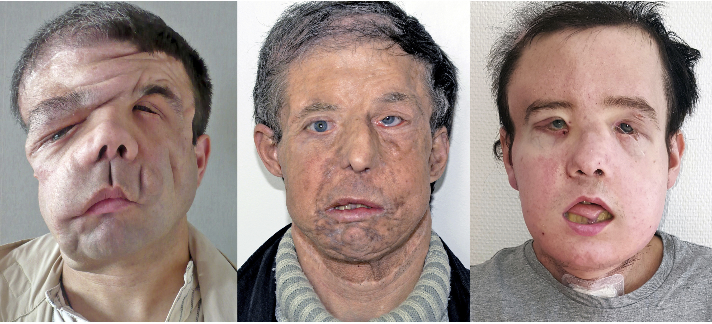 Французин е първият с две трансплантации на лице
