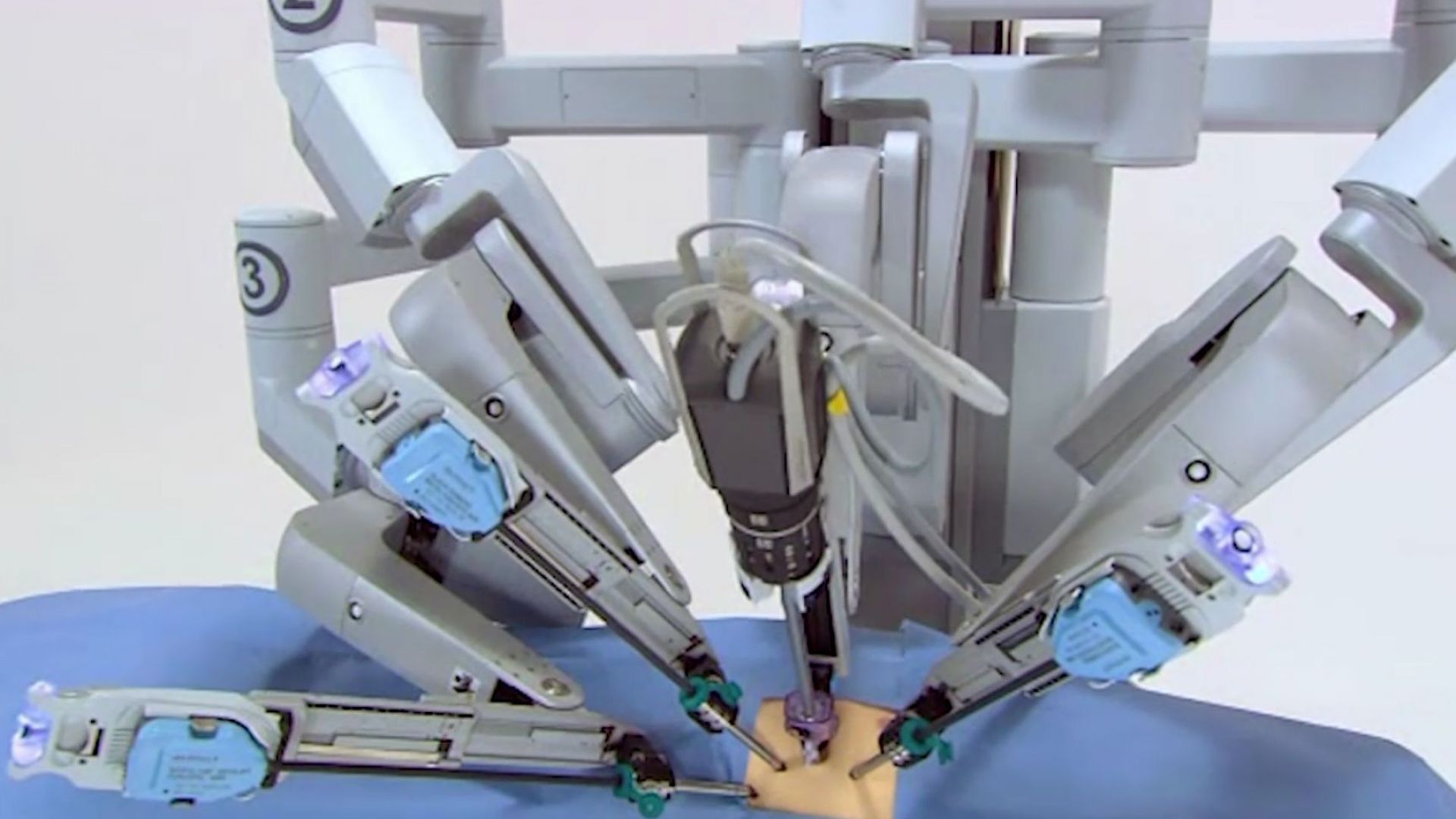 Уникална операция с робот извършиха в Плевен