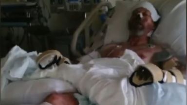 Ампутираха краката и част от ръцете на мъж заради инфекция от куче (видео)