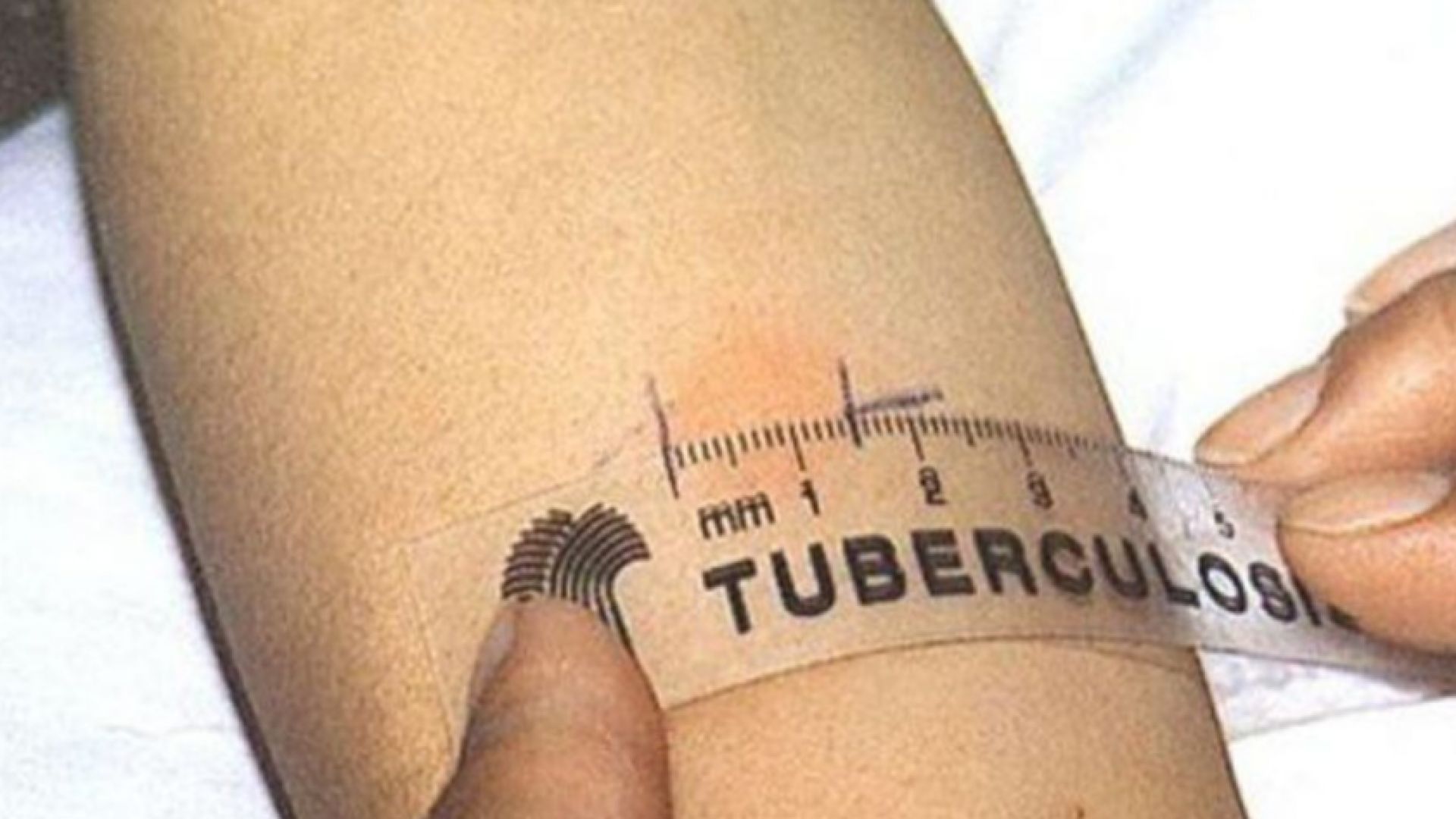 Безплатен скрининг за риска от туберкулоза ще се проведе от