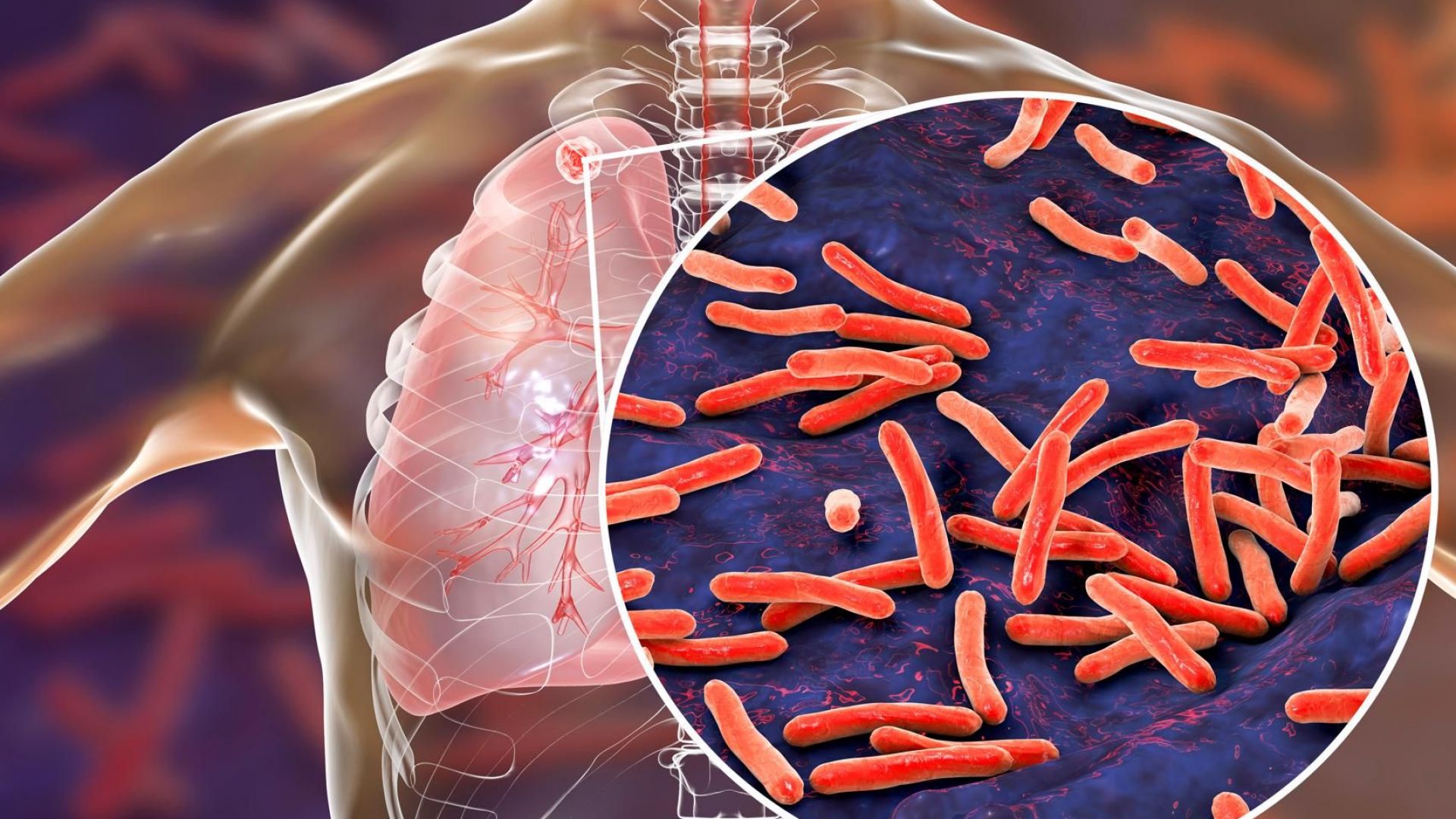 Световната здравна организация определи туберкулозата като най страшната и смъртоносна за