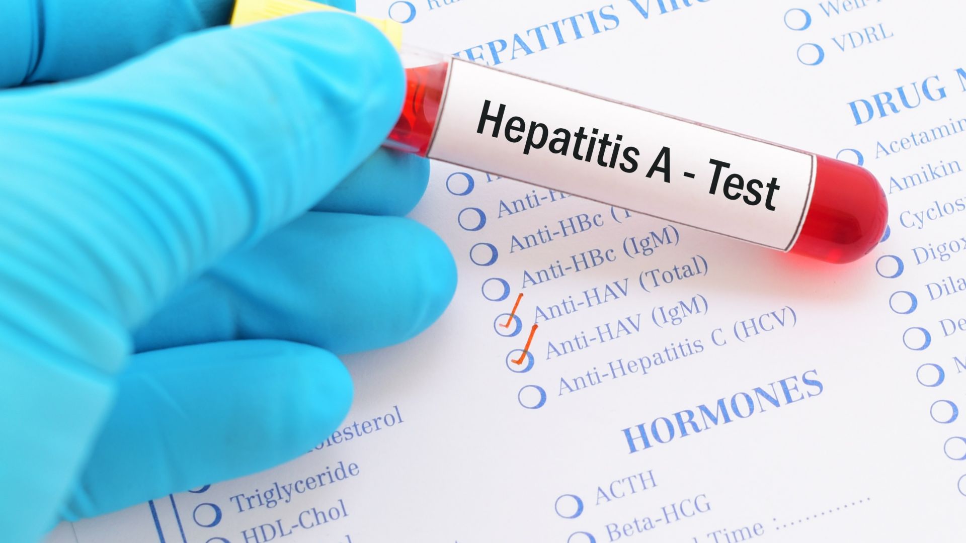 Хепатит А в над 20 столични училища и детски градини