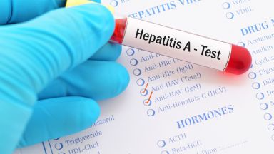  Хепатит А в над 20 столични учебни заведения и детски градини 