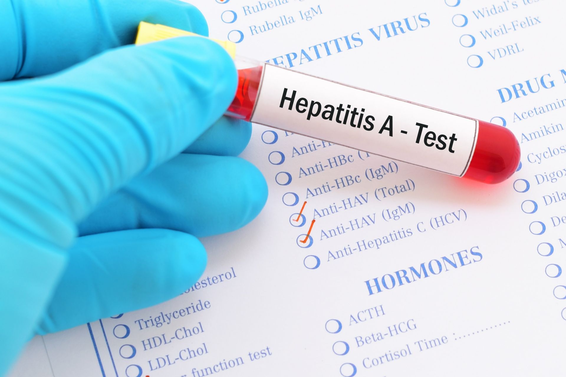В инфекциозното отделение в Хасково са настанени повечето болни с хепатит А, повечето от тях - деца