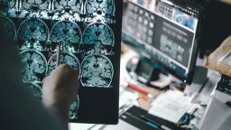 Специалисти изясниха защо жените по-често са засегнати от болестта на Алцхаймер