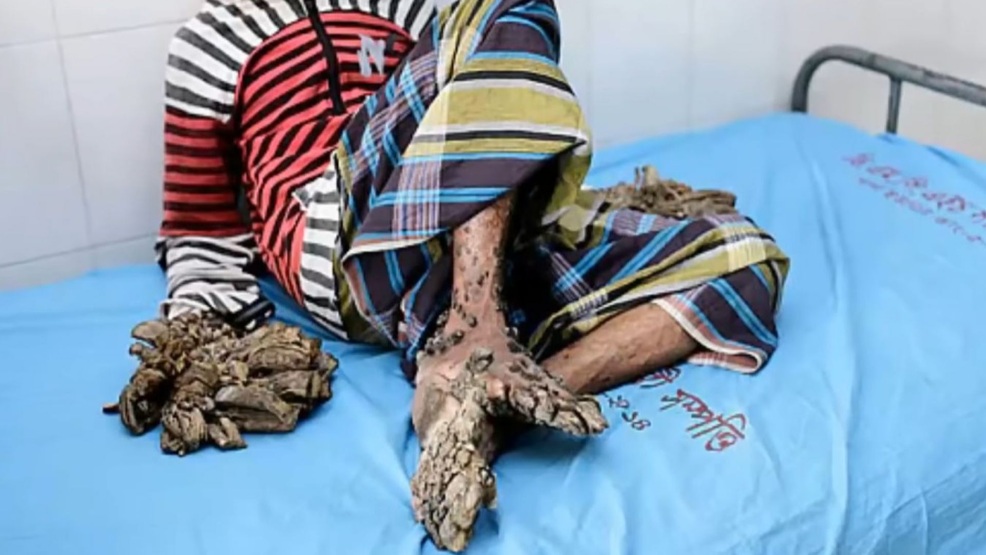 Мъж от Бангладеш който стана известен като човека дърво заради