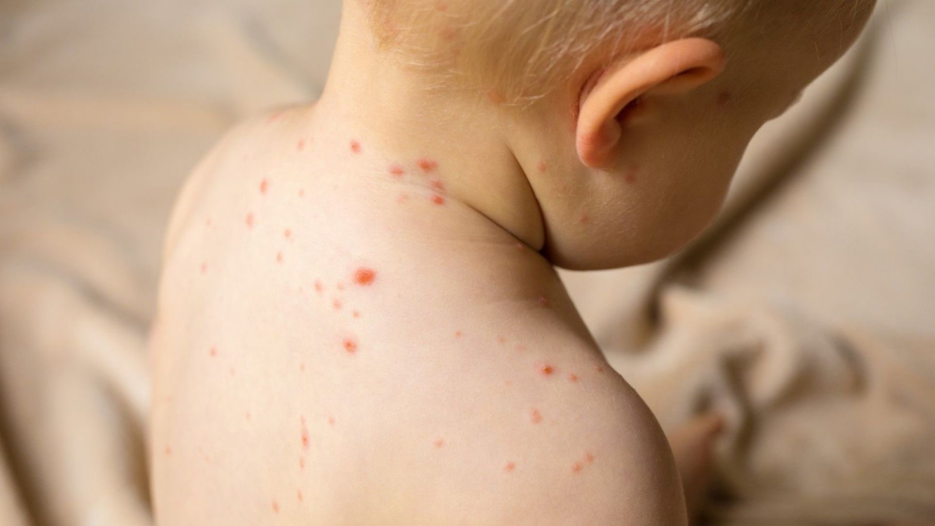 Още 12 души имат клинична картина на морбили дребна шарка