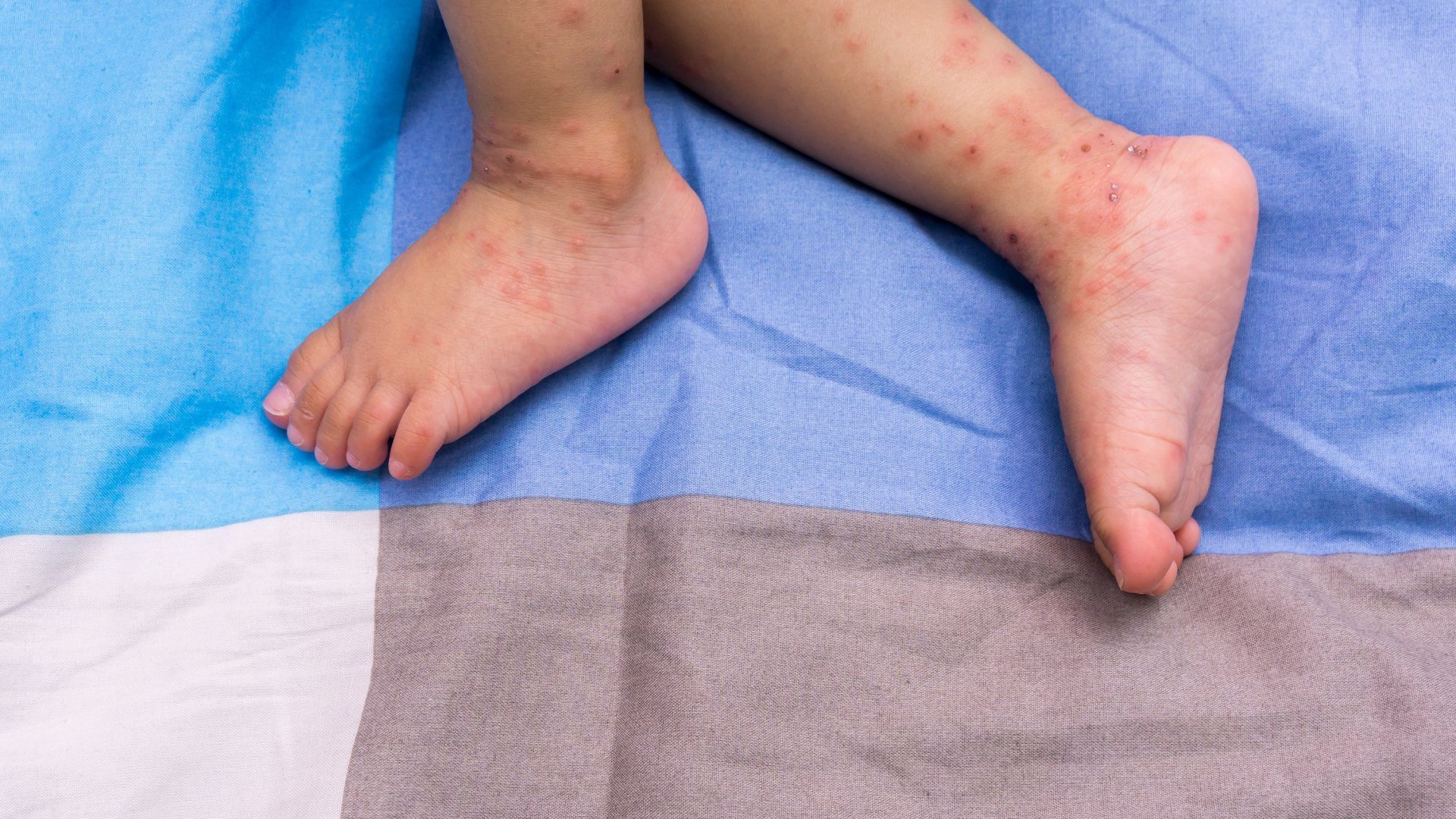 Шейсет и шест са пациентите с данни за морбили като