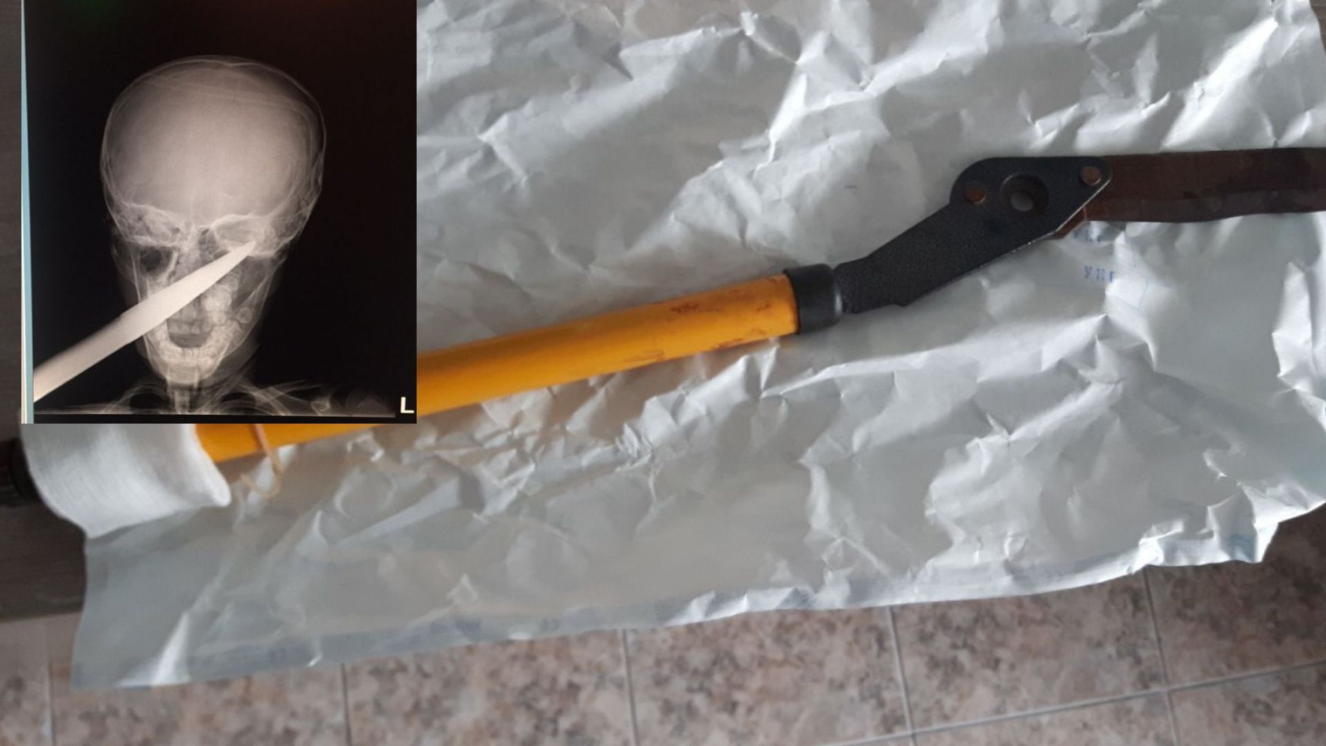 Хирурзите в Университетската болница в Бургас спасиха живота на 7 годишно