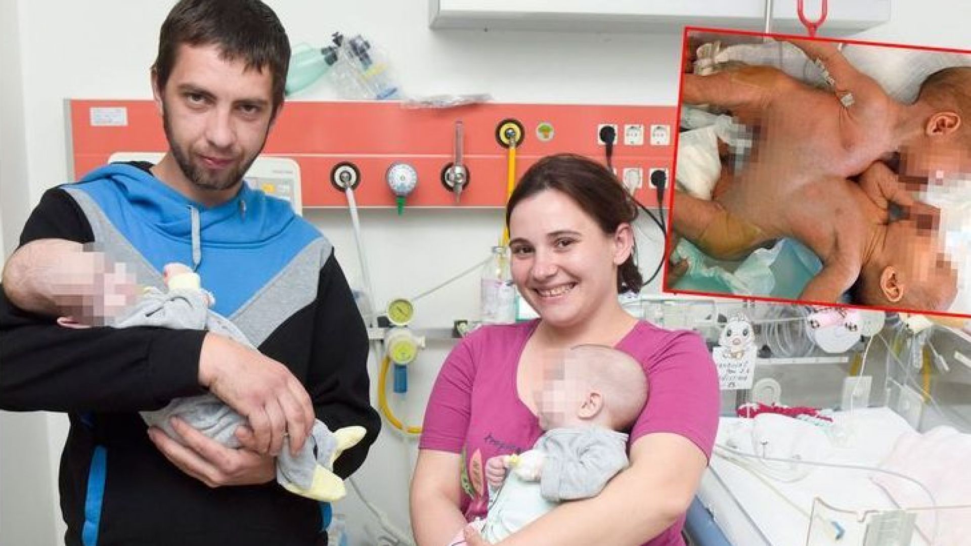 Хърватски лекари успешно разделиха сиамски близначки свързани с коремни органи