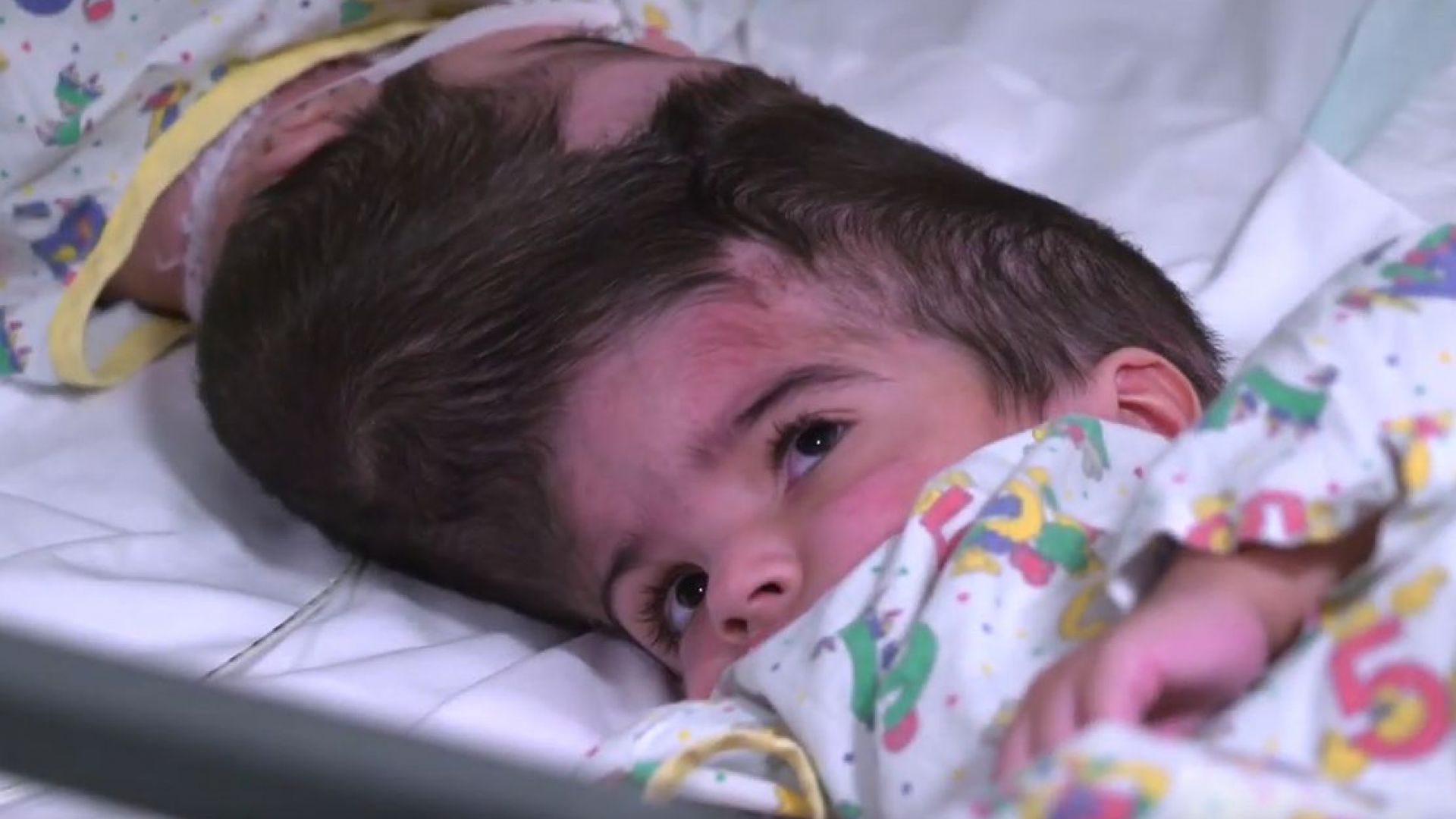 Британски лекари обявиха че са разделили успешно с няколко операции