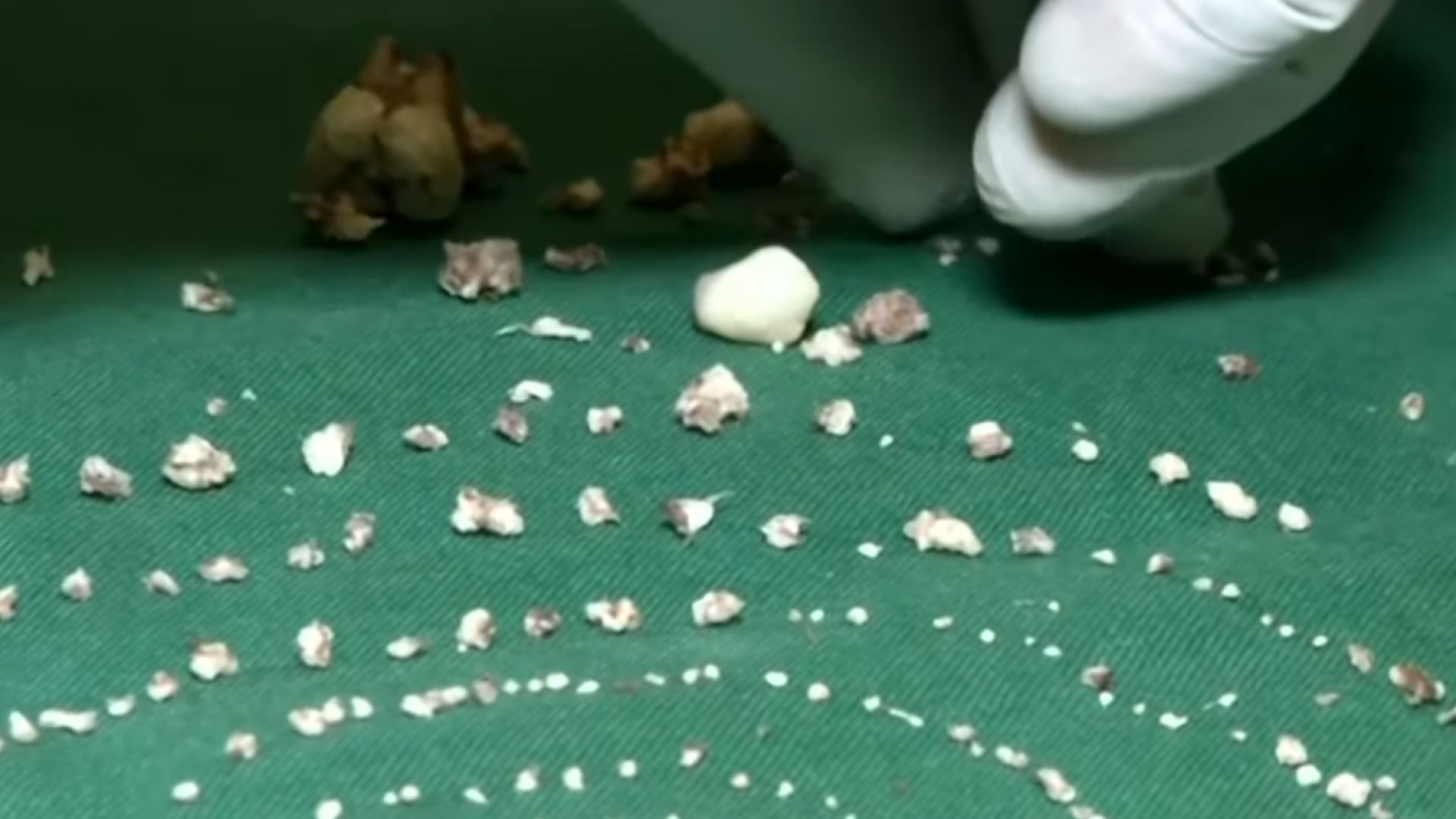 Дентални хирурзи от болницата в град Ченай извадиха от устата