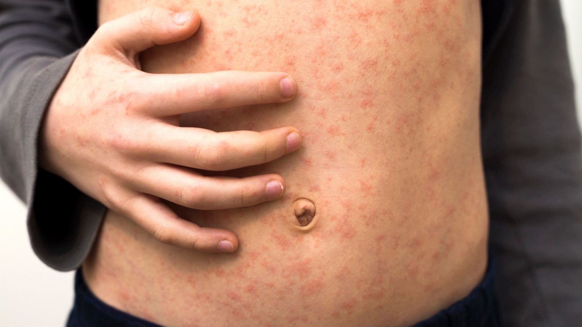 Светът се сблъсква с нова епидемия от морбили защото вирусът