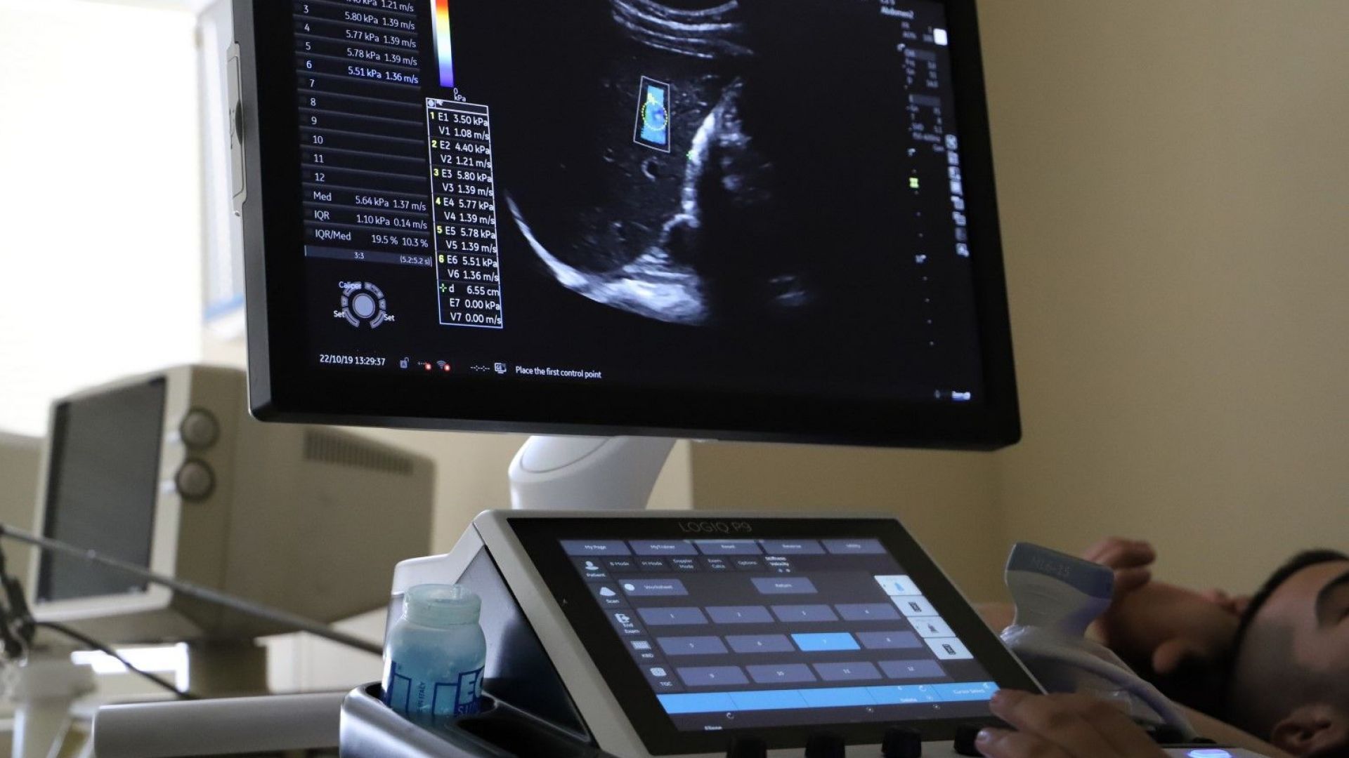 Най съвременната апаратура за неинвазивно без биопсия диагностициране на вируса на