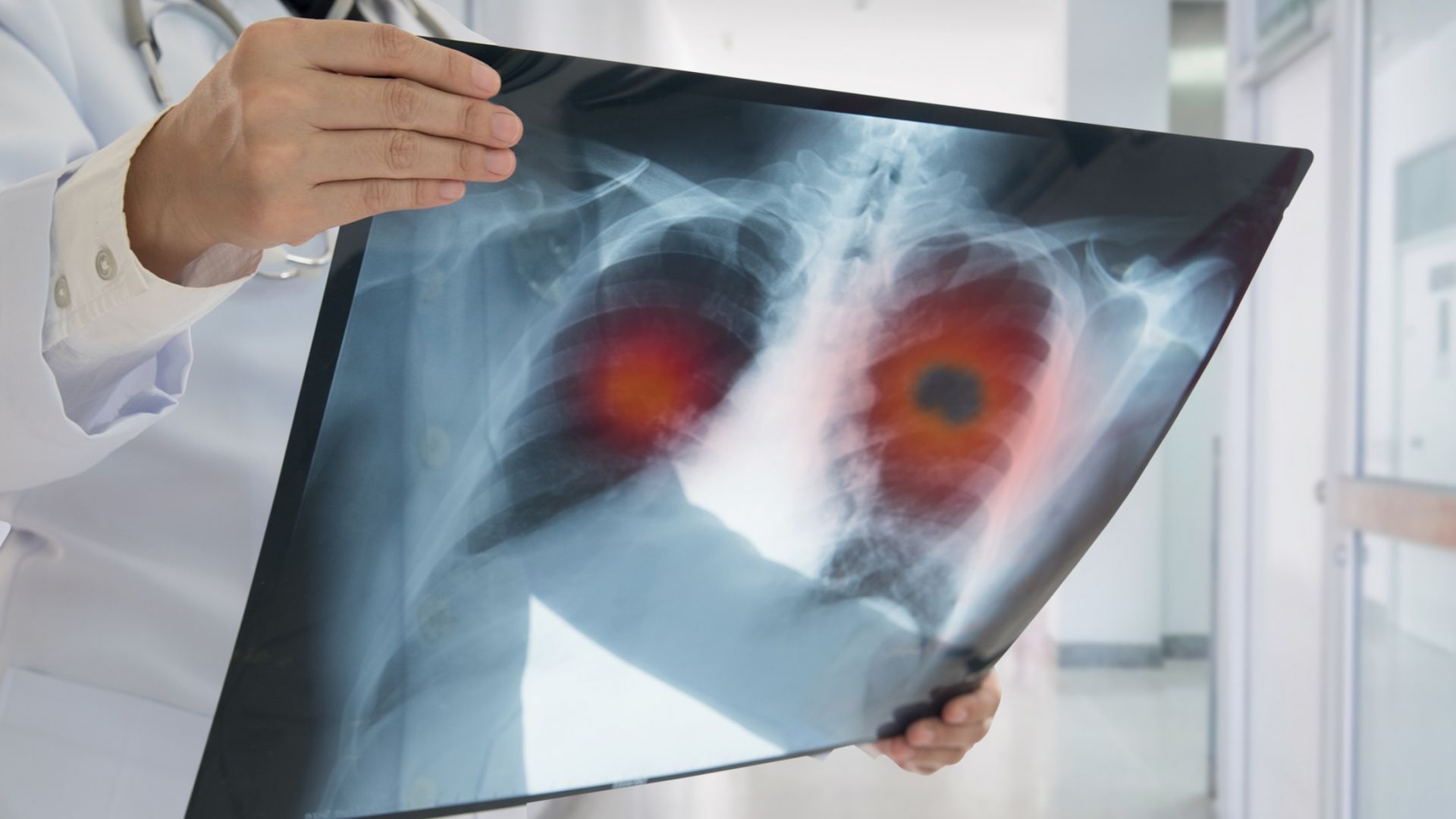 Над 4000 българи годишно получават диагноза рак на белия дроб