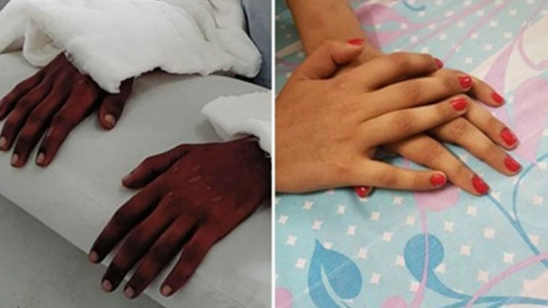 Ръцете преди и след операцията