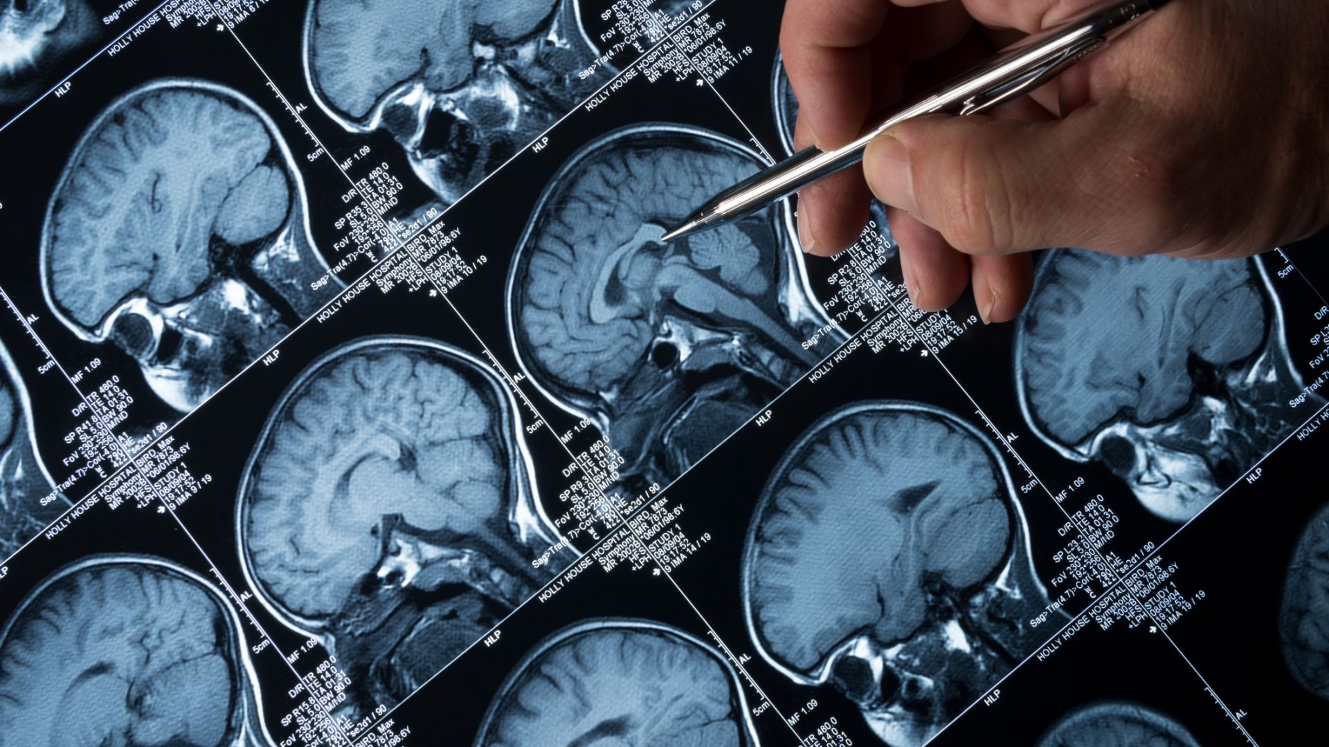 Изкуствен интелект идентифицира симптоми на Алцхаймер с приказката за Пепеляшка