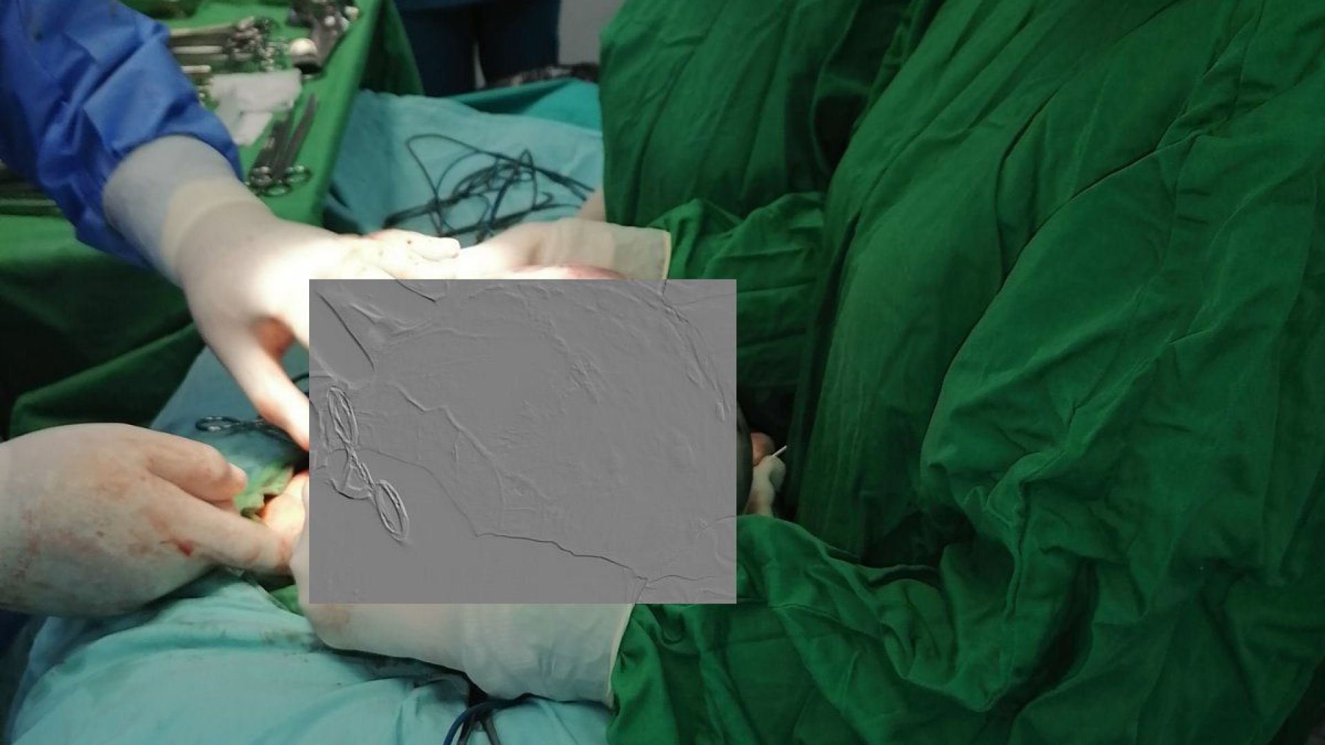 Извадиха 12-килограмов тумор от корема на пациентка в "Света София"