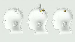 Учени: Проектът за мозъчни импланти на Мъск е ужасяващ
