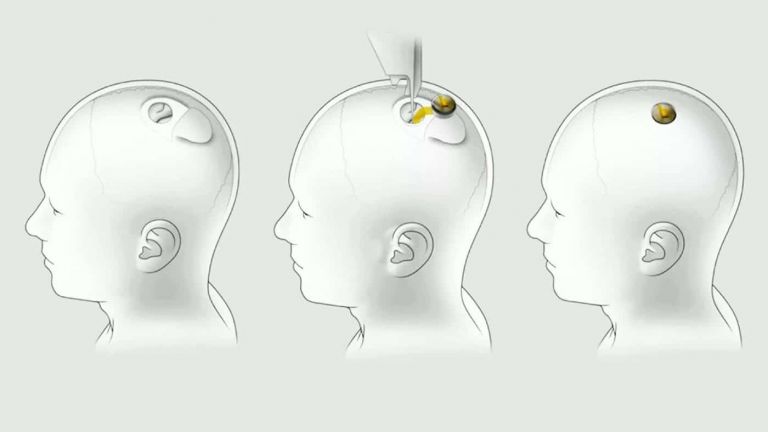 Photo of Ils ont retiré l'implant cérébral Neuralink de la tête du premier patient testé