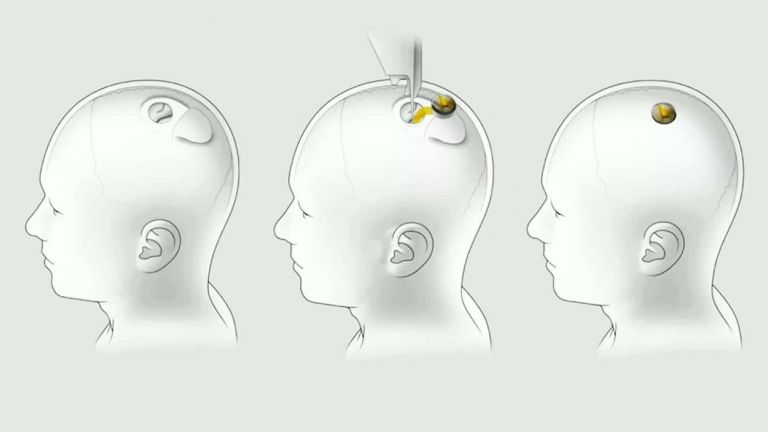 Ils ont retiré l'implant cérébral Neuralink de la tête du premier patient testé Ils ont retiré l'implant cérébral Neuralink de la tête du premier patient testé