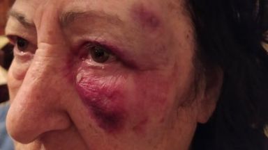 Жена пострада тежко заради разбит тротоар в Шумен (снимки)