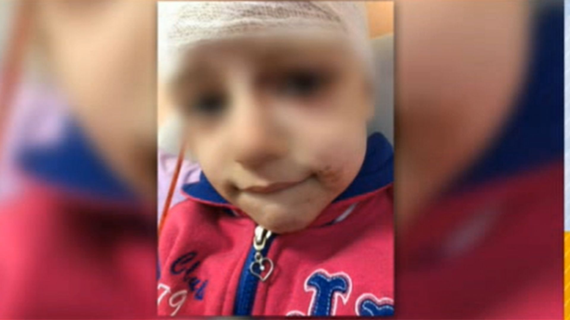 Питбул нахапа 4-годишно момиченце в София, с две фрактури на черепа е