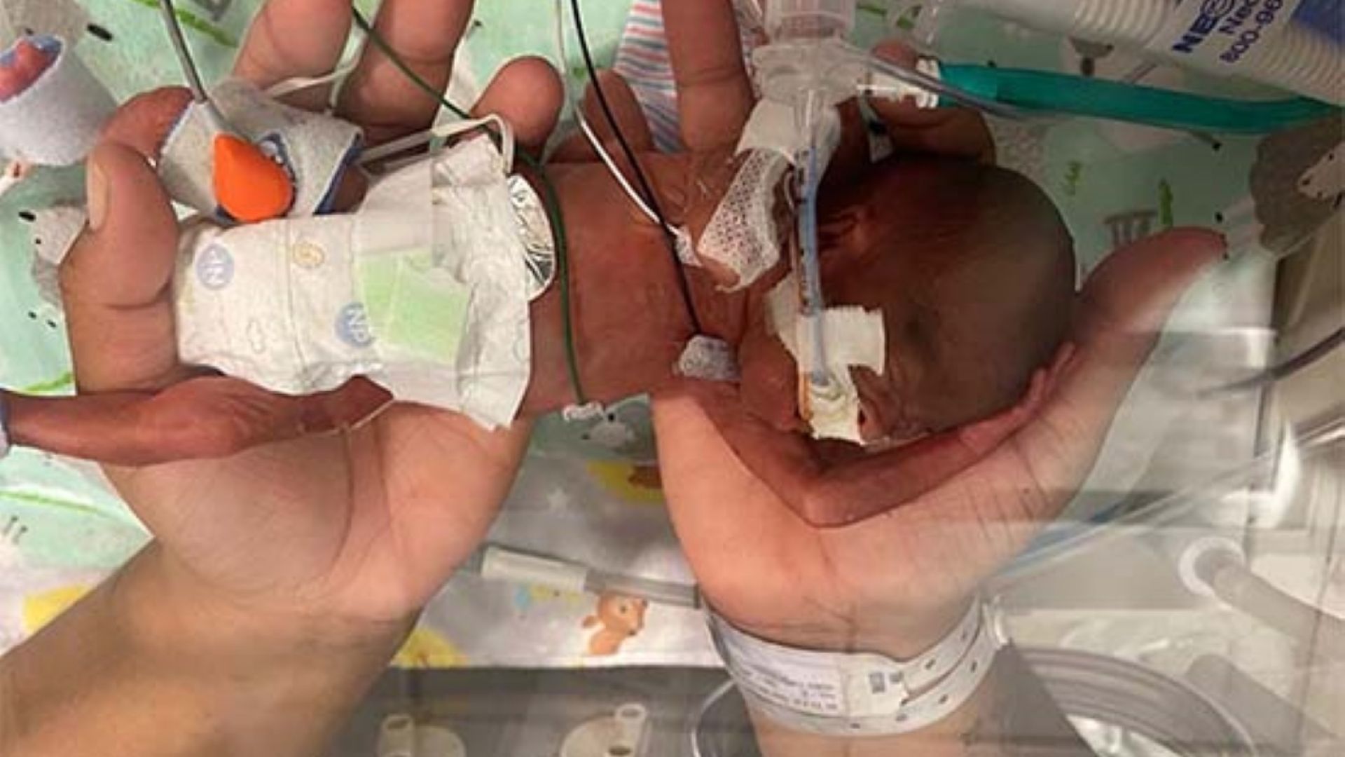 Момче от Алабама е вписано в Гинес като най-недоносеното бебе на света - 420 грама
