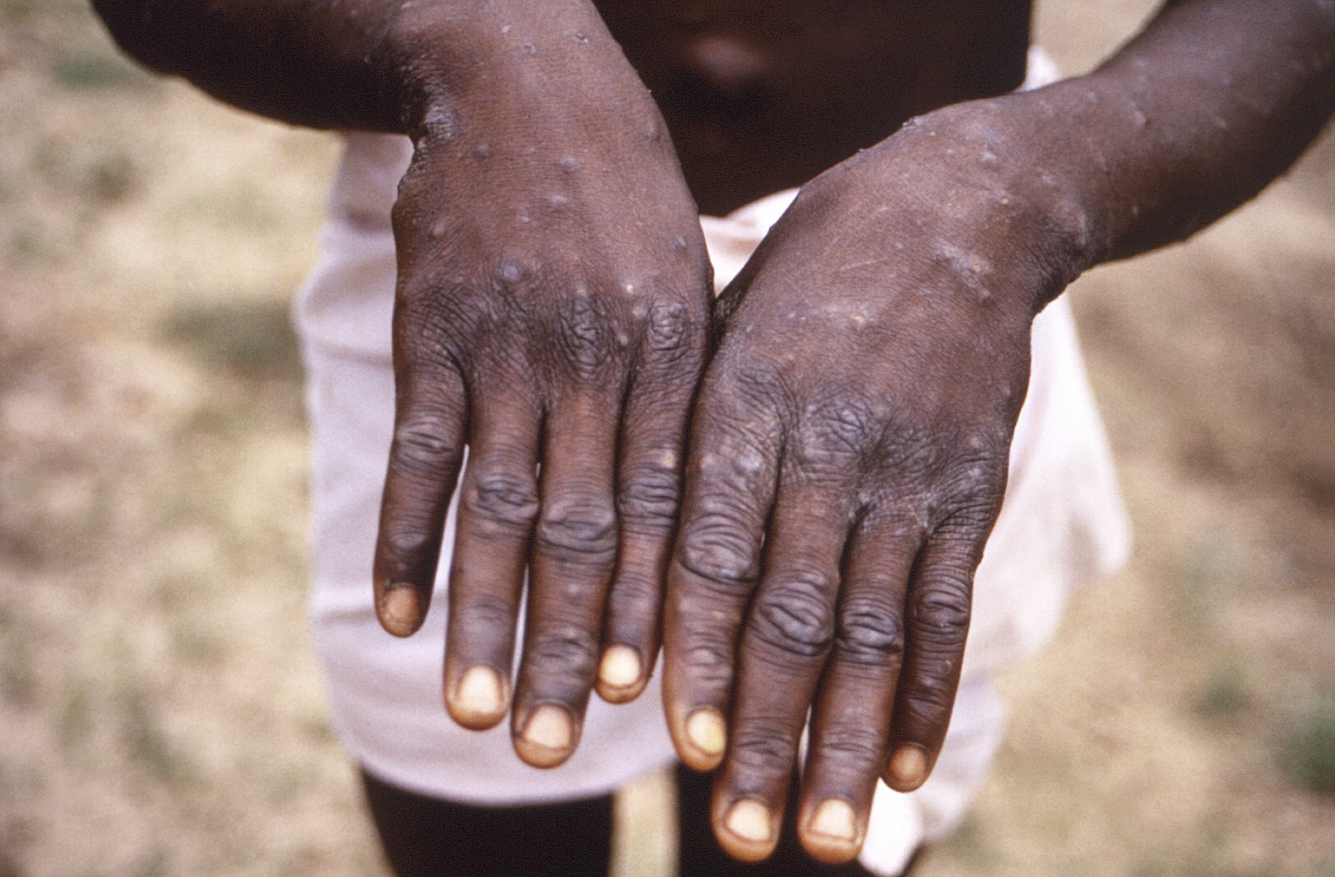 Типичен обрив по ръцете на пациент с маймунска шарка по време на възстановителния му стадий - случай от Заир през 1997 г.