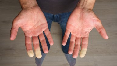 Студени пръсти и задебеляване на кожата могат да са признаци на животозастрашаващо заболяване