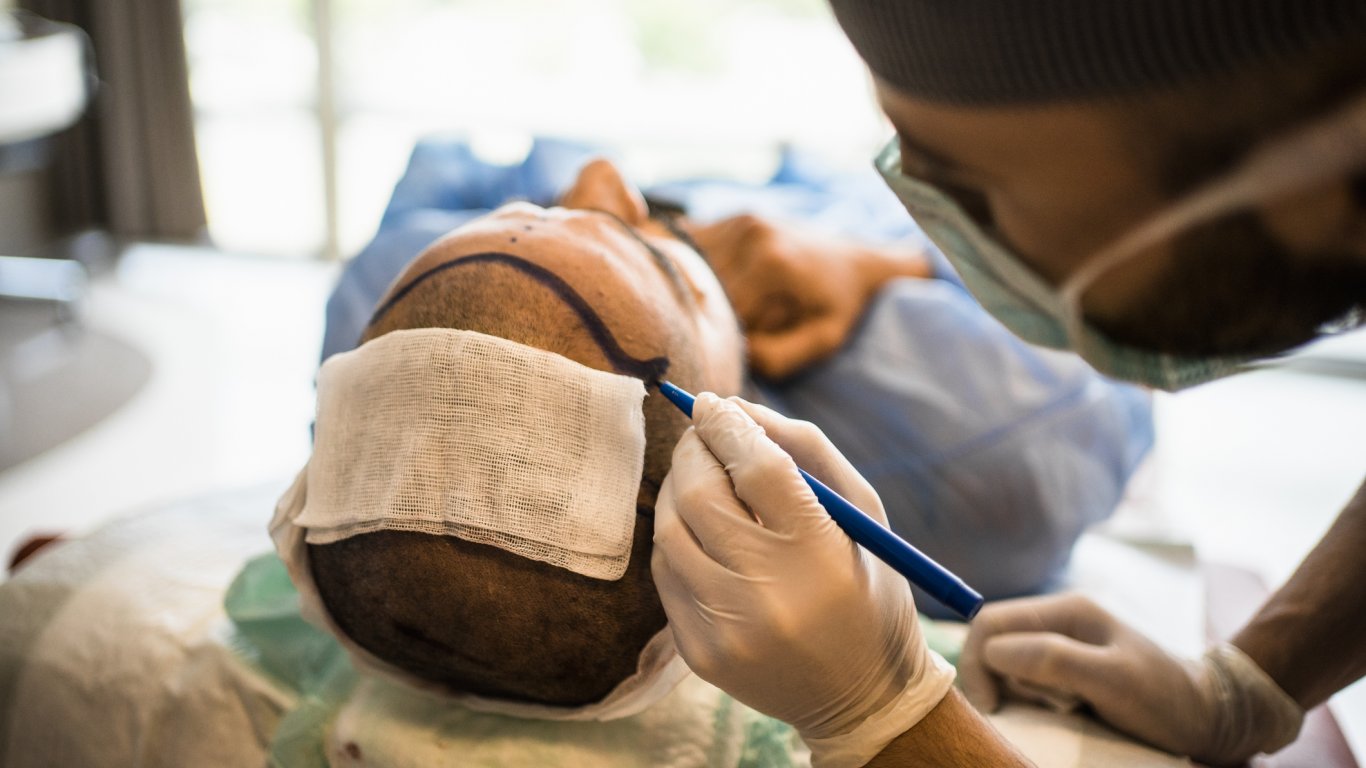 Заради слабата лира: Азиатци препълниха турските клиники за трансплантация на коса