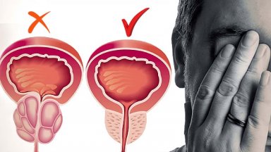Доброкачествената хиперплазия на простатата аденом се приема за основна причина
