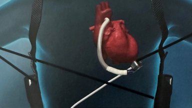 Устройството е имплантирано на 37 годишен пациент с терминална сърдечна недостатъчност