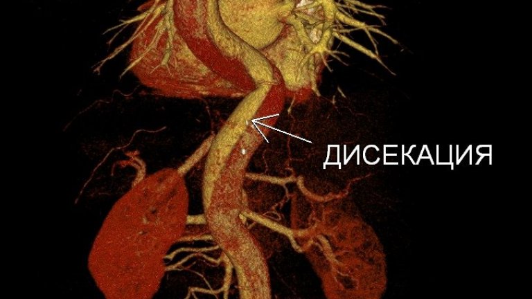 Кардиохирурзи спасиха 49-годишен мъж с пълно разкъсване на аортата