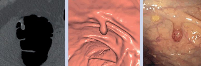Полип, видян на виртуална колоноскопия и стандартна колоноскопия