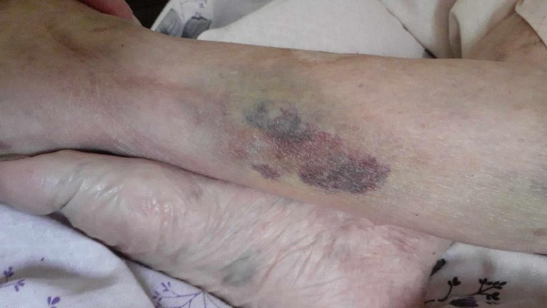 Вързана, гладна и жадна: Роднини на 104-годишна жена с обвинения към видинската болница (снимки)